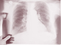 Gastric acid drug lansoprazole may also treat tuberculosis