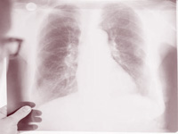 Global targets on TB unreachable: Experts