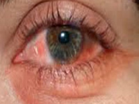 Rise in conjunctivitis cases in city