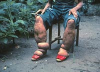 Vector control, drug infusion to check filariasis
